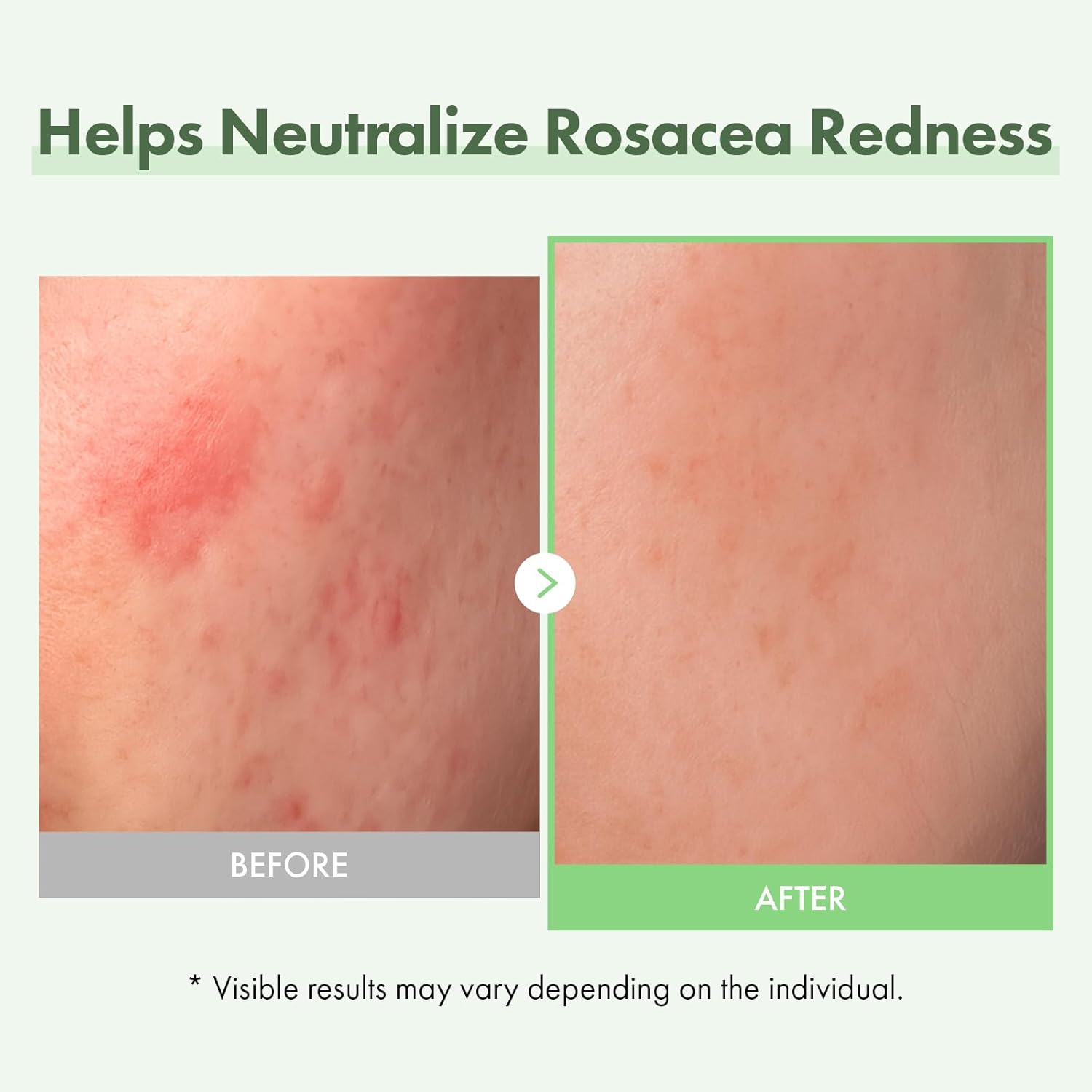 TOSOWOONG Azelaic Acid 10% Face Serum – Redness Soothing, Rosacea & Blemish Care